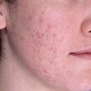 ¿Cómo desaparecer mis cicatrices del acné en la cara? 