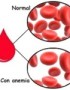 ¿Alguien se puede morir de anemia?