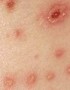 ¿Es posible contagiarse de varicela por segunda vez?