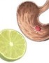 Beneficios del limón para curar la úlcera gástrica