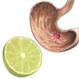 Beneficios del limón para curar la úlcera gástrica