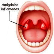 Conociendo la amigdalitis