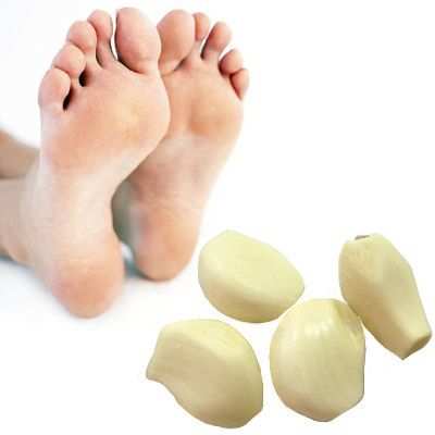 Propiedades y beneficios del ajo para los hongos del pie de atleta