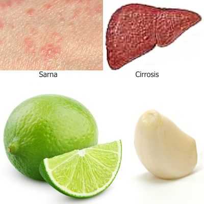 2 Remedios caseros usando limón: para la cirrosis y para la roña, Sarna en  el cuerpo humano